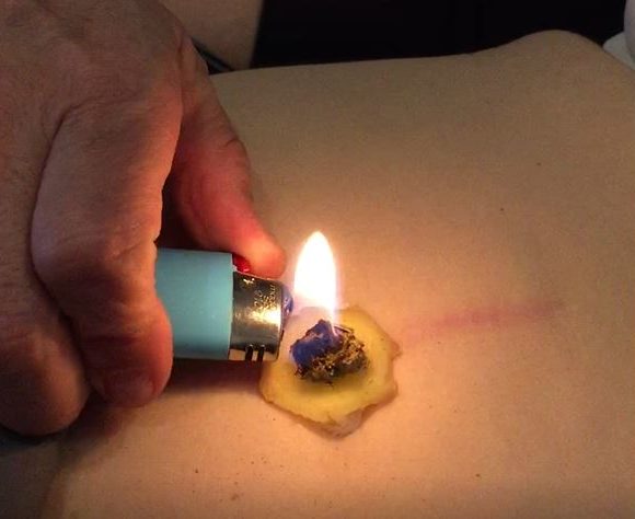 Moxibustion – Eine Zusatztherapie in der Akupunktur